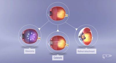 Risiken senken mit Myopie-Management bei Kindern